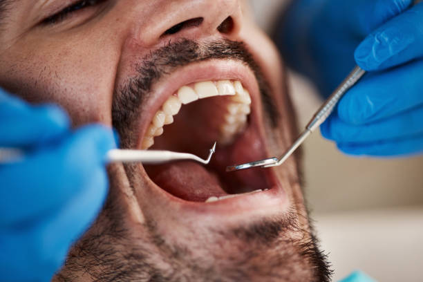 Emergency Dental Filling Replacement in MI